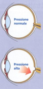 glaucoma