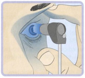 glaucoma