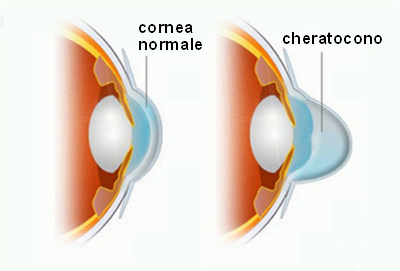 cheratocono