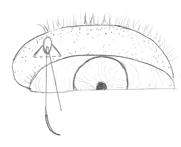 FIG. 2 Tecnica dei tre tagli (three snips). Utilizzando un paio di forbici piccole ed a punta stretta (Vannas) si eseguono 2 tagli verso il basso, per 2 mm, ad angolo acuto (30 gradi), con partenza rispettivamente 1mm a destra e 1mm a sinistra del filo.