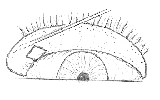 FIG. 3 Eversione palpebrale inferiore. L’eversione della palpebra inferiore viene ottenuta aiutandosi con una sonda di Bowman inserita nel canalicolo inferiore.