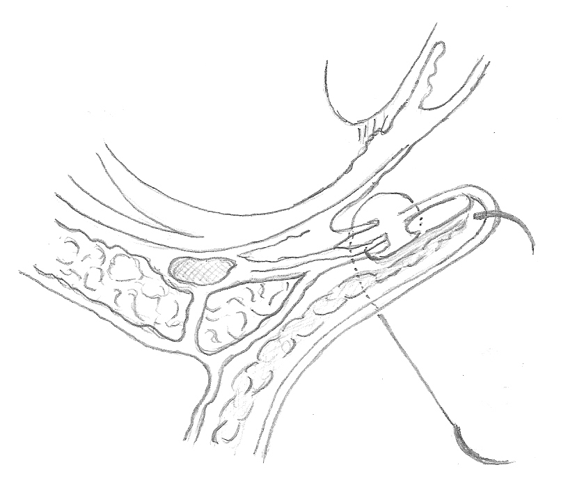 FIG. 6 Passaggio a tutto spessore attraverso la palpebra. Tutti e due gli aghi vanno poi passati dal fornice inferiore, a tutto spessore, attraverso la palpebra e fatti fuoriuscire, sulla cute, 12mm inferiormente al margine palpebrale.