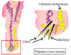 blefarite cause