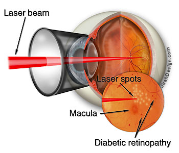 Retinopatia sintomi