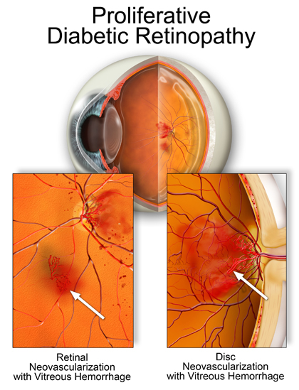 Retinopatia Diabetica rd-proliferativa