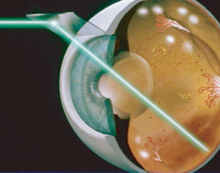 Retinopatia Diabetica trattamento-laser-RD