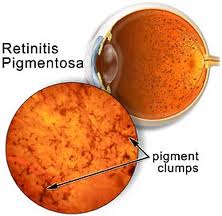 Retinite Pigmentosa