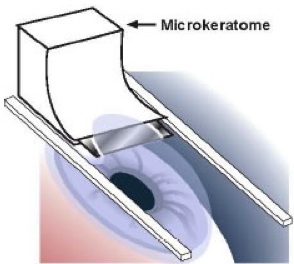 microcheratomo