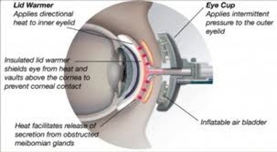 08-lipiflow