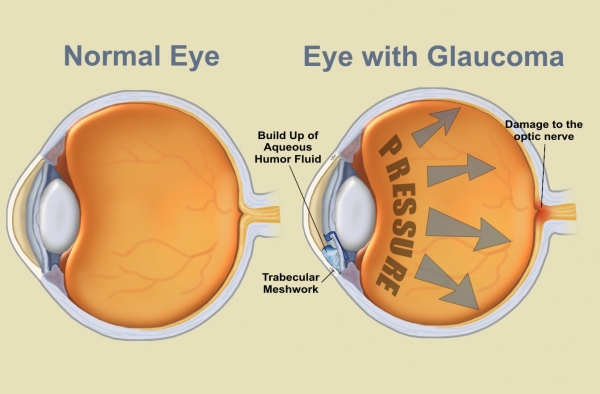 carlo.orione_occhio_normale_e_con_glaucoma