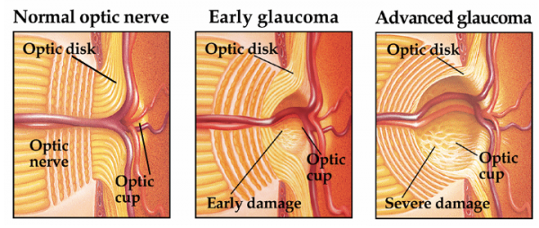 carlo.orione_glaucoma_fasi_danno_nervo_ottico