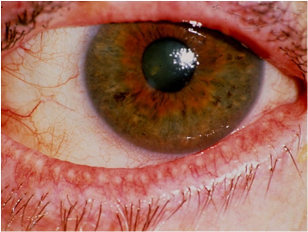 Luce pulsata e Radiofrequenza per curare occhio secco e blefarite (IPLRF) 2