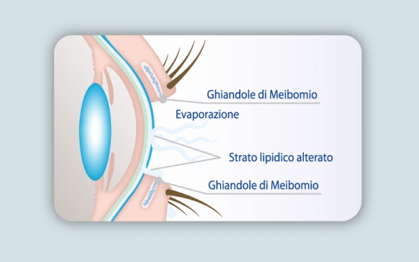 Luce pulsata e Radiofrequenza per curare occhio secco e blefarite (IPLRF) 3