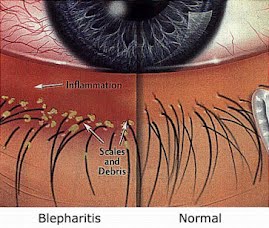 Luce pulsata e Radiofrequenza per curare occhio secco e blefarite (IPLRF) 8