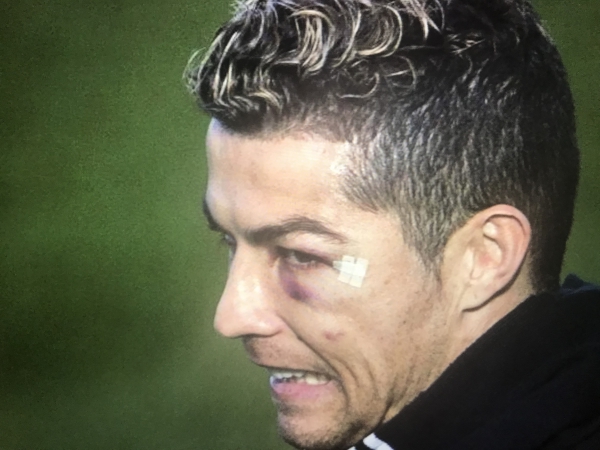 Cristiano Ronaldo e chi gioca a calcio puó subire un trauma agli occhi