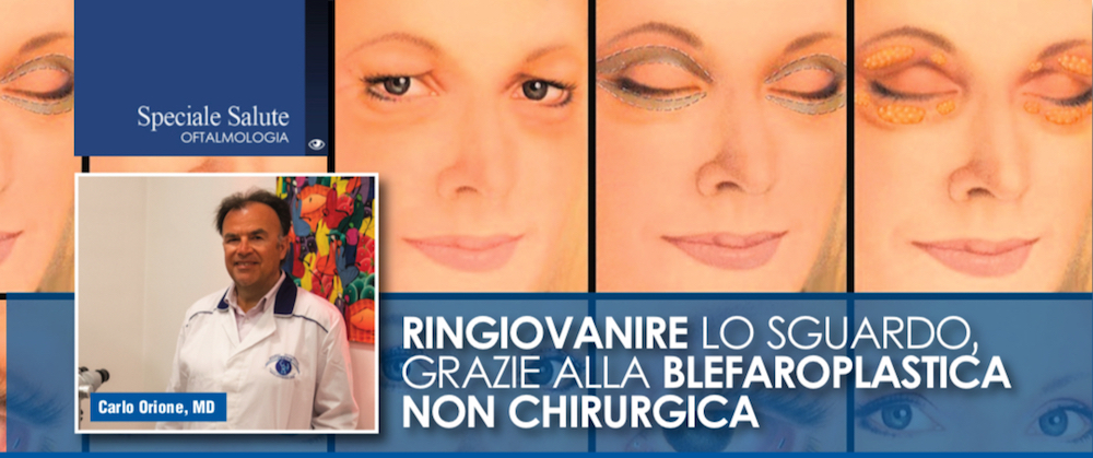 Ringiovanire lo sguardo, grazie alla blefaroplastica non chirurgica