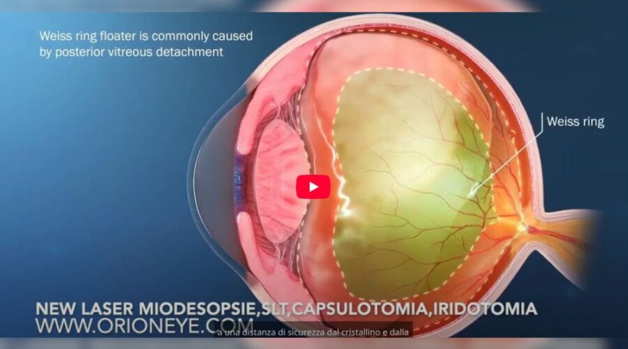 Miodesopsie vitreali quando i corpi mobili non sono più innocui